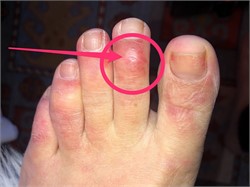 'COVID Toes' Might Be a Sign That a Person is Infected with the Novel Coronavirus
